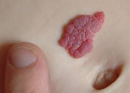 Hemangioma Kapiler